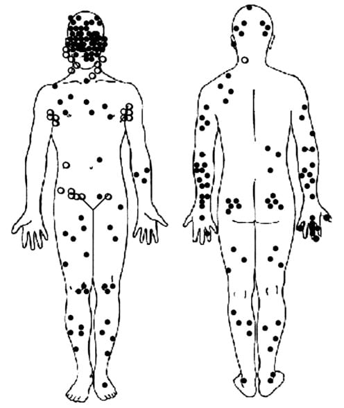 Where MCC occurs on the body
